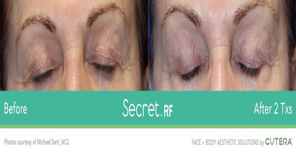 Secret RF // Before & After